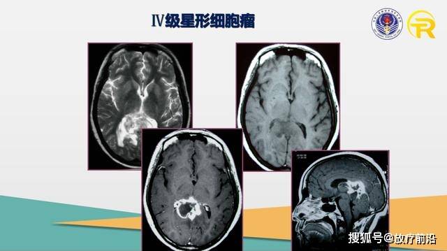 胶质瘤最新治疗方法和手段探索