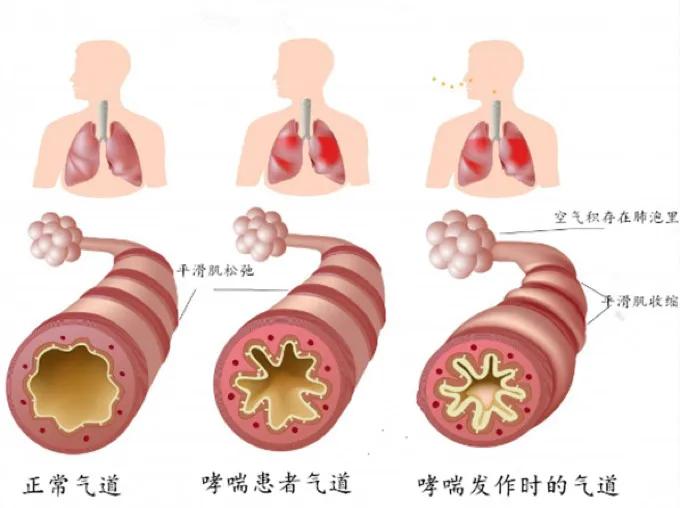 最新版气道管理指南发布，提升气道护理质量与患者安全保障